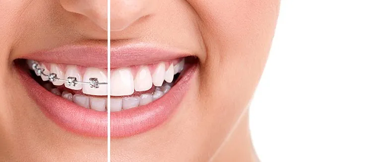 Can+You+Switch+from+Braces+to+Invisalign