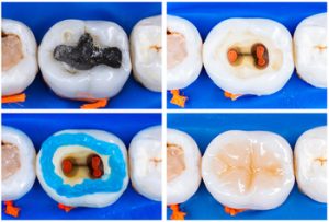 Amalgam,(mercury),Filling,Replacing,With,Ligt,Cure,Composite,After,Root